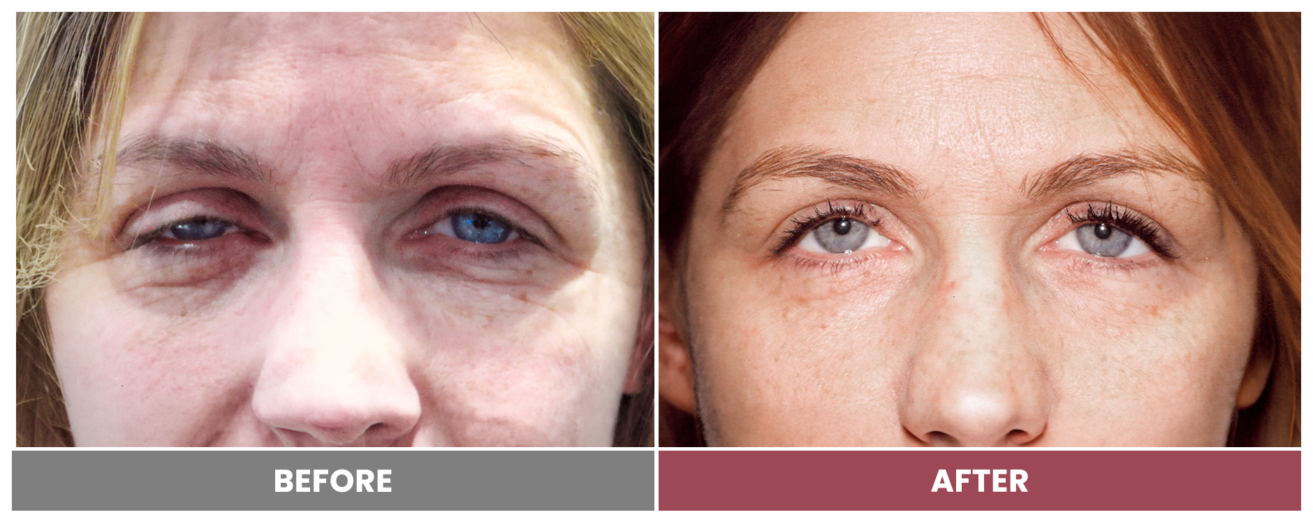 PTOSIS REPAIR - Case 10